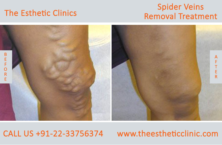 Spider Veins Removal Varicose Veins Laser Treatment before after photos mumbai india (1 (4)